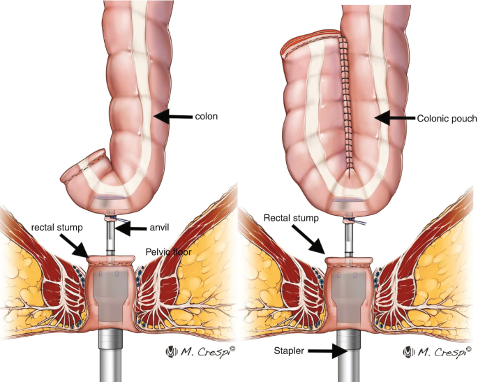 Anterior Resection (LAR) Surgery_AthAyush
