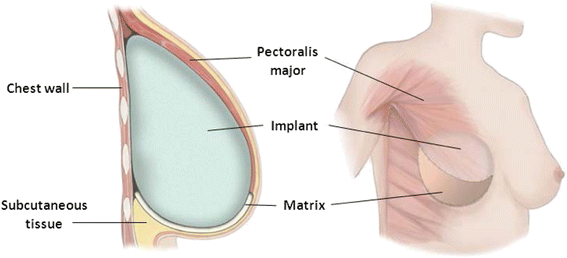 Modified Radical Mastectomy Surgery_AthAyush