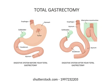 Total Gastrectomy Surgery_Ath_Ayush